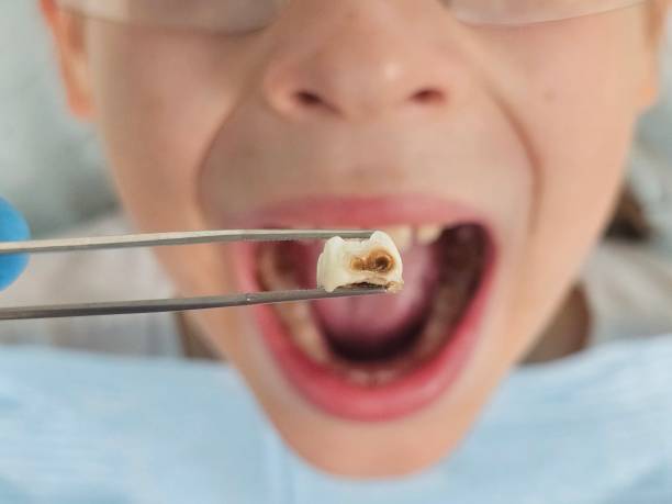 Best Emergency Dental Care for Broken or Chipped Teeth in West Lawn, PA