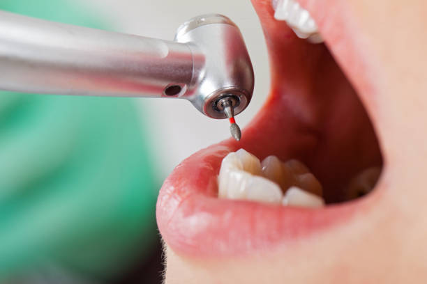 Best Emergency Treatment for Dental Infections or Abscesses in West Lawn, PA